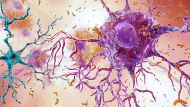 Artist’s rendition of an unhealthy brain neuron